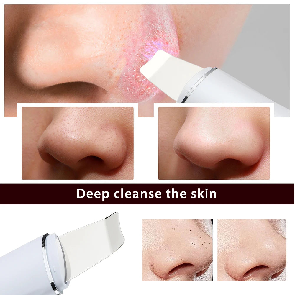 Ultrasonic Skin Scrubber Peeling Blackhead Remover Deep Face Cleaning Ultrasonic Ion Acne Pore Cleaner Facial Shovel  Scrubber